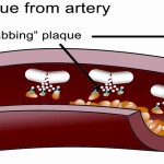 EDTA Removes Plaque from arteries