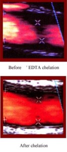 Before and After EDTA